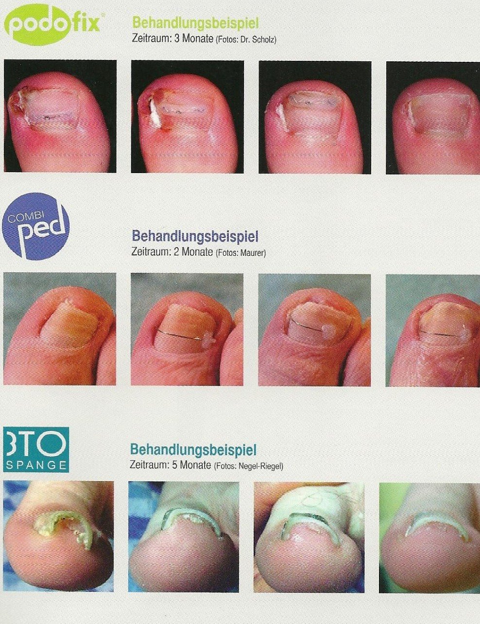 Orthonyxiebehandlung fuer Kinder Erwachsene und auch bei Diabetikerpatienten moeglich